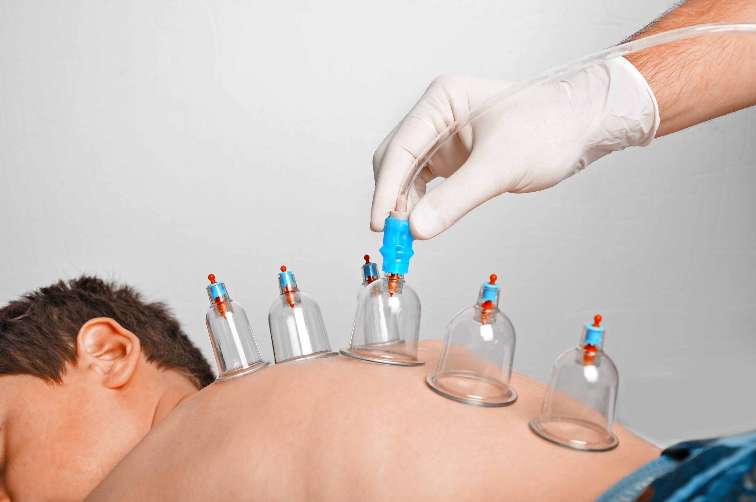 Cupping Therapy